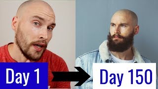 5 MONTH MINOXIDIL BEARD TRANSFORMATION [upl. by Yerak]