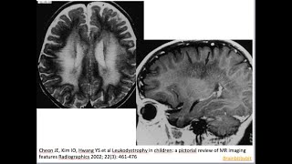 49 Metachromatic leukodystrophy MLD arylsulfatase A deficiency lysosomal tigroid pattern [upl. by Singband]