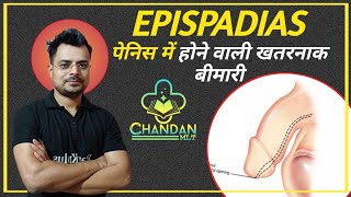 Epispadias in hindi  Epispadias  causes  symptoms  Diagnosis treatment  Chandan Mlt  RanKplus [upl. by Yatnahs]