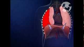 hemothorax [upl. by Eserehc]