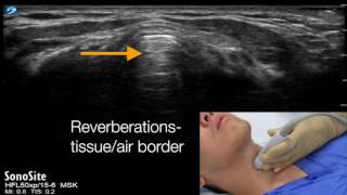 Cricothyroid membrane identification with ultrasound  transverse approach [upl. by Akived]