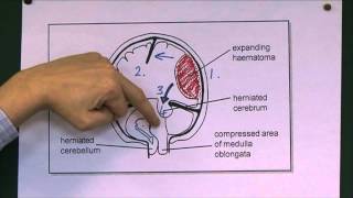 Head Injuries 9 Tentorial herniation [upl. by Ahsehat]