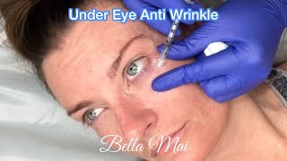 3 Areas amp Under Eye Jelly Roll Anti Wrinkle Botox  Before During amp After [upl. by Bryanty213]