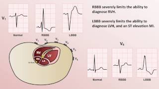 Intro to EKG Interpretation  Bundle Branch Blocks [upl. by Trill578]