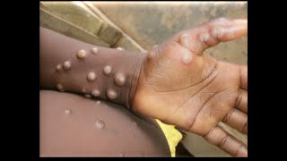 Indwara y Ubushita Bw Inkende MPox Mpox Disease Monkeypox CreditsRBCampMOH RWANDA [upl. by Marrilee]