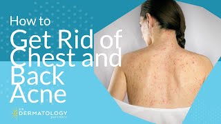 How to Get Rid of Chest and Back Acne [upl. by Meredithe]