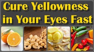 Causes of Yellow Eyes and How To Get Rid of Yellow Eyes Fast at Home  Yellow Eyes [upl. by Cumings]