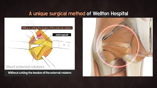 ENG Total Hip Replacement Surgery  Reason to Preserve the Piriformis Muscle [upl. by Lolanthe]