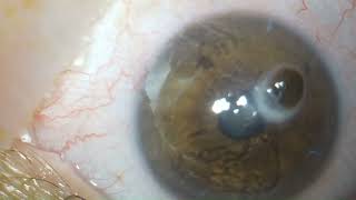 Transplante tectônico de córnea Corneal patch graft for corneal perforation with iris protrusion [upl. by Allesig]