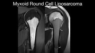 Myxoid Round Cell Liposarcoma [upl. by Krongold634]