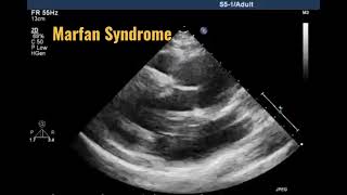 Echo in Marfan Syndrome [upl. by Adnamas]