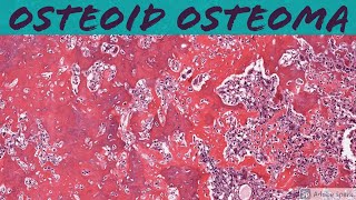 Osteoid Osteoma Bone Pathology Basics [upl. by Welch]