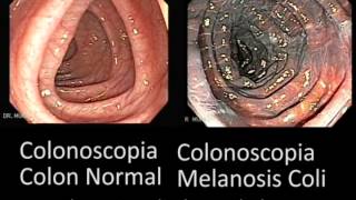 Comparación Colon Normal y Colon con Melanosis Coli [upl. by Nordna429]