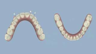 Invisalign  Midline Shift and IPR  Dr Thomas Gibbs DDS [upl. by Ecirtra]