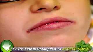 How Angular Cheilitis Cream Works [upl. by Nesyla]