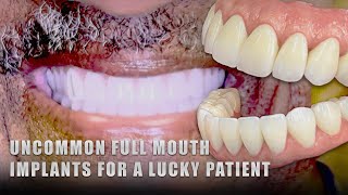 Uncommon Full Mouth Implants for a Lucky Patient [upl. by Caines]