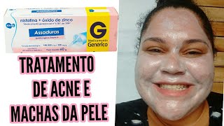 Aplicando a Pomada Nistatina no Rosto  Melasma  Acne PomadaNistatinaOxidodeZinco [upl. by Oniotna]