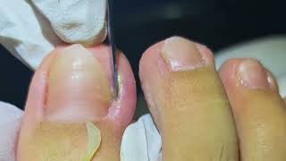 Trimming and Removing Infected Ingrown Toenails [upl. by Brenden801]