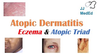 Eczema Atopic Dermatitis  Atopic Triad Triggers Who gets it Why does it happen amp Treatment [upl. by Akem907]