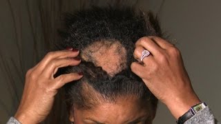 What Is Causing This Woman’s Extreme Hair Loss [upl. by Ahsilahs]