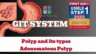 USMLE Step1 Polyp and its types Adenomatous Polyps from first aid step 1USMLEUrduHindi [upl. by Augy]