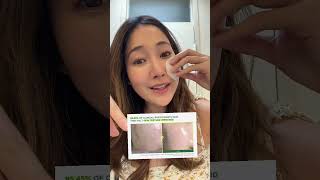 Korean skincare for acne amp textured skin kbeauty koreanskincare skincare acne skincareroutine [upl. by Ecyor656]