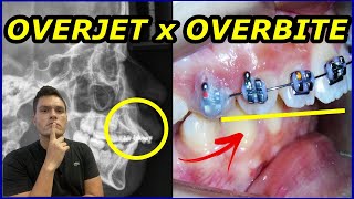 OVERJET x OVERBITE  QUAL A DIFERENÇA  COMO O DENTISTA CORRIGE COM APARELHO [upl. by Alvord171]