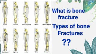 What is bone fracture types of bones fractures [upl. by Clougher]