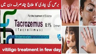 Tacrozemus ointment  eczema Causes amp Treatment  How to get rid of Eczema  vitiligo Skin Care [upl. by Evalyn591]