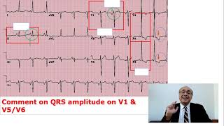 EKG Trainer Case 5 Questions [upl. by Auqkinahs]