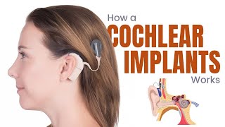 Cochlear Implants What are they and How do they work  3D Guide [upl. by Aiekahs]