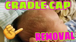 SUPER EASY AND NATURAL WAY TO REMOVE CRADLE CAP [upl. by Perlman468]