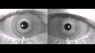 Nystagmus on Infrared Goggles [upl. by Ettenad400]