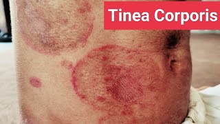 Understanding and Treating Tinea Corporis Expert Guide [upl. by Akenat854]