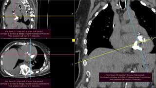 Calcificação do anel mitral MAC como é o aspecto nos exames complementares [upl. by Anitreb]