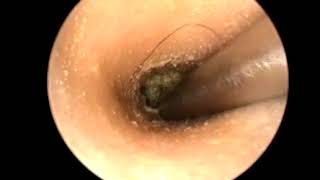 Earwax Removal Extractions From a Kid Part 2 Tweeze Out Earwax 小朋友来复诊 外耳道挖耳屎清理 耳垢 耳垢 [upl. by Analra]