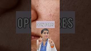 Open Pores  How to get rid of pores on face  Large pores treatment shorts [upl. by Zamir713]