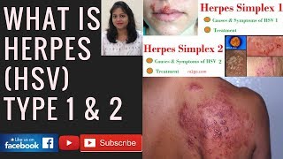 What is Herpes HSVHerpes Simplex VirusHuman Herpesvirus 1 and 2 [upl. by Cariotta]