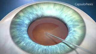 Cataract Surgery Animation [upl. by Kcirederf97]