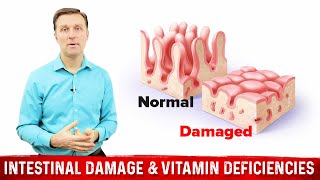 Intestinal Obstruction amp Vitamin Deficiencies – Dr Berg [upl. by Jocelyn]