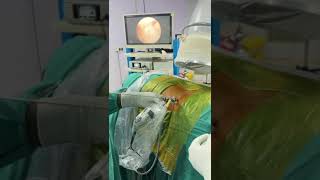 Endoscopic spine surgery [upl. by Eira]