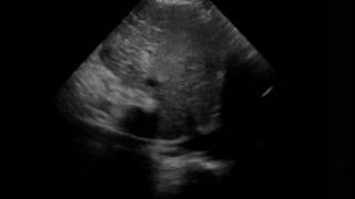 IVC Fully Collapsing with Spontaneous Respiration [upl. by Marinna]