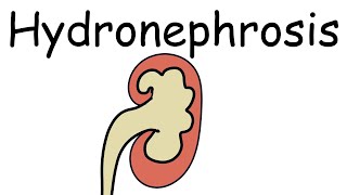 What is Hydronephrosis Causes Presentation Complications and Treatment  Pathology mini tutorials [upl. by Laresa]