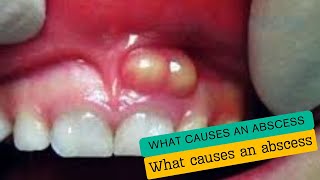 What causes an abscess [upl. by Lorelle]