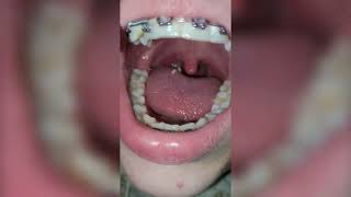 Deep Tonsil Stone Removal  Tonsil Stones [upl. by Phipps]