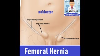 Femoral HerniaFemoral Canal Anatomy Groin HerniaInguinal Hernia SurgeryLap Hernia surgery [upl. by Asenej646]