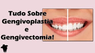 Aula de Periodontia  Tudo Sobre Gengivoplastia e Gengivectomia  Indicações e Passo a Passo [upl. by Eleahcim]