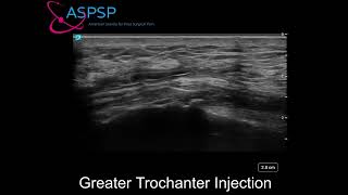 Ultrasound Guided Greater Trochanteric Bursa Injection [upl. by Taber]