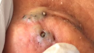 lots of big blackheads behind the ears satisfying video [upl. by Norrad775]