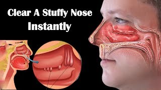 How to Get Rid of a Stuffy Nose Fast  8 Home Remedies for Stuffy Nose During Pregnancy [upl. by Bridgette]